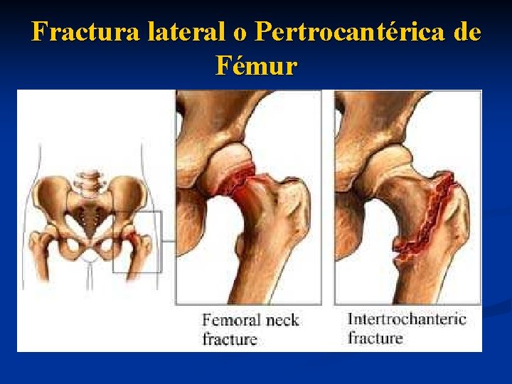 Fractura lateral o Pertrocantérica de Fémur 