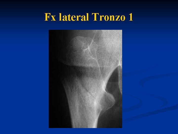  Fx lateral Tronzo 1 