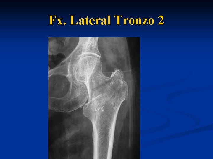  Fx. Lateral Tronzo 2 