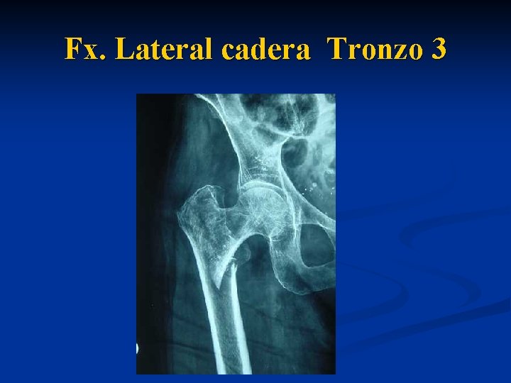 Fx. Lateral cadera Tronzo 3 