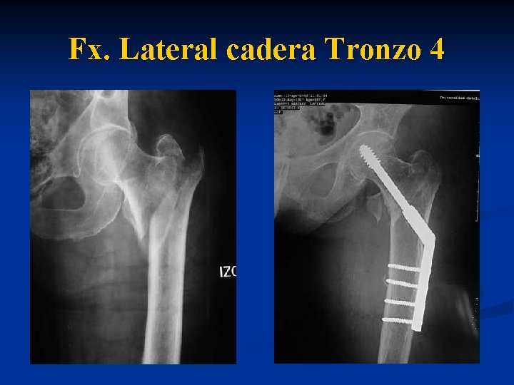  Fx. Lateral cadera Tronzo 4 