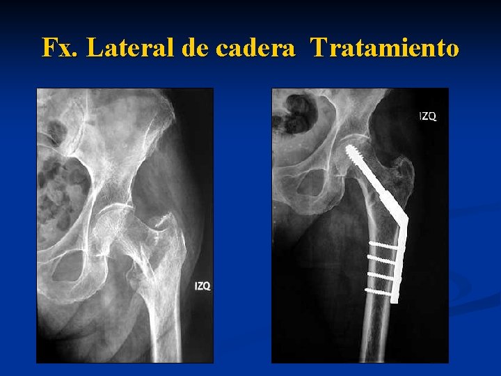 Fx. Lateral de cadera Tratamiento 