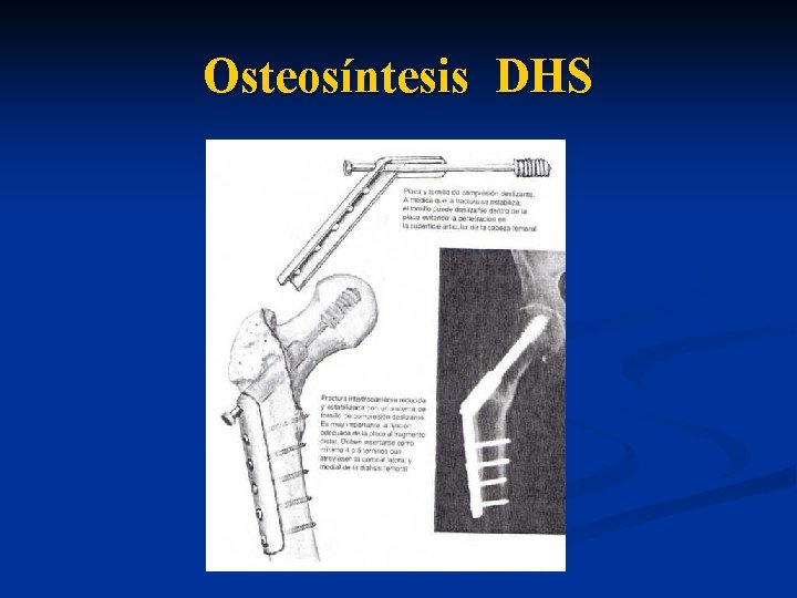 Osteosíntesis DHS 