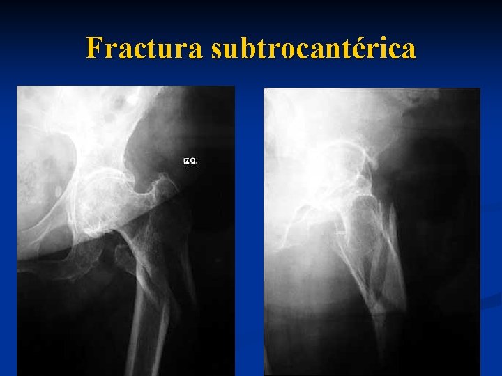 Fractura subtrocantérica 