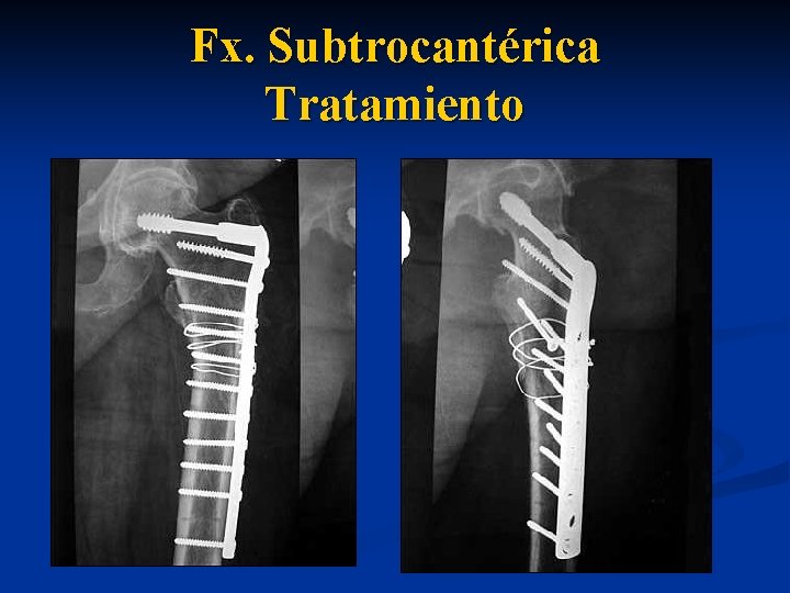 Fx. Subtrocantérica Tratamiento 