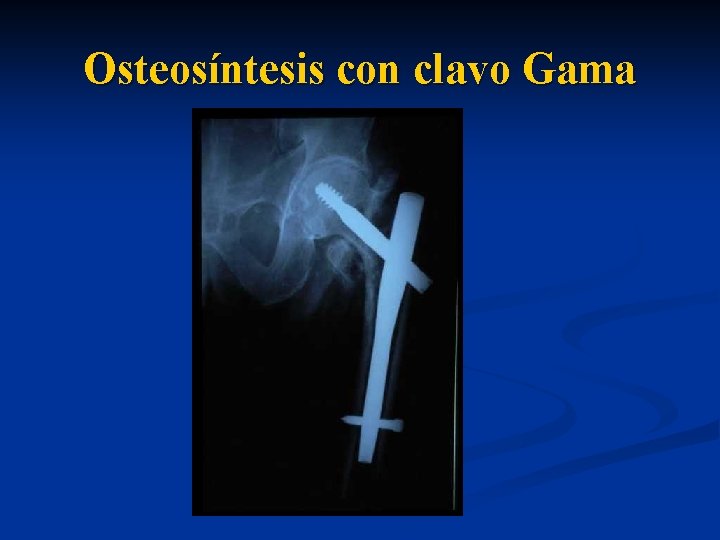Osteosíntesis con clavo Gama 