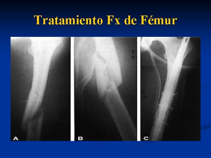 Tratamiento Fx de Fémur 