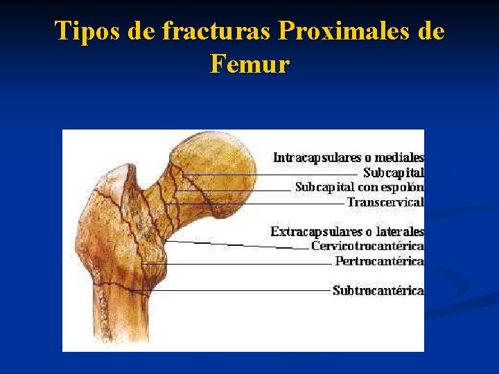 Tipos de fracturas Proximales de Femur 