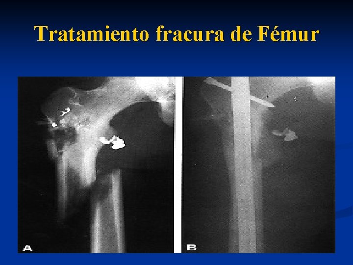 Tratamiento fracura de Fémur 