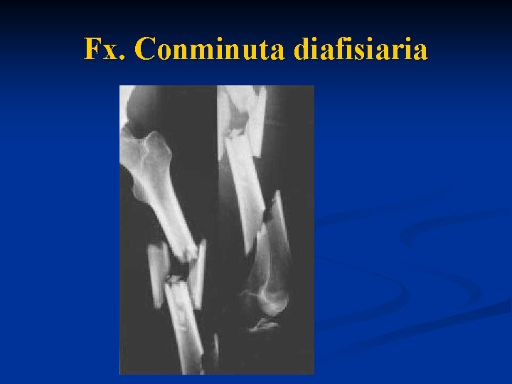 Fx. Conminuta diafisiaria 