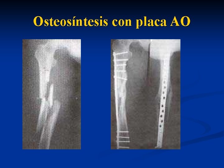  Osteosíntesis con placa AO 