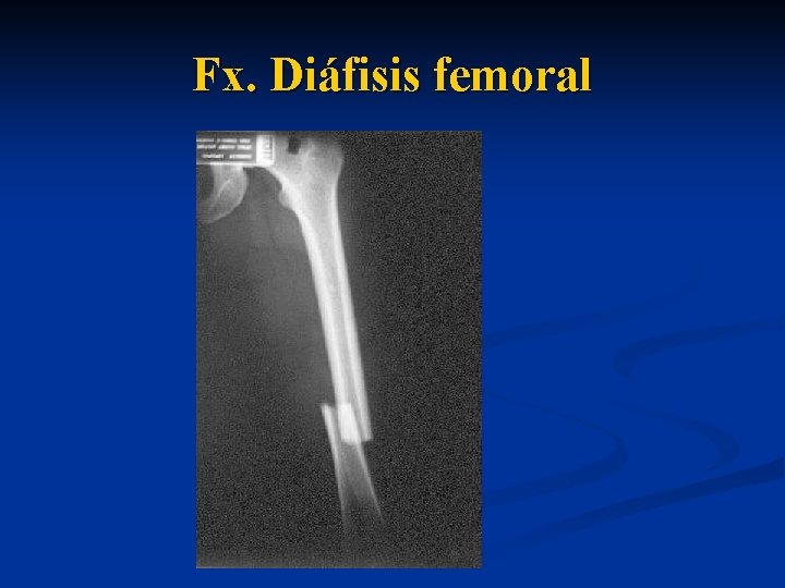  Fx. Diáfisis femoral 