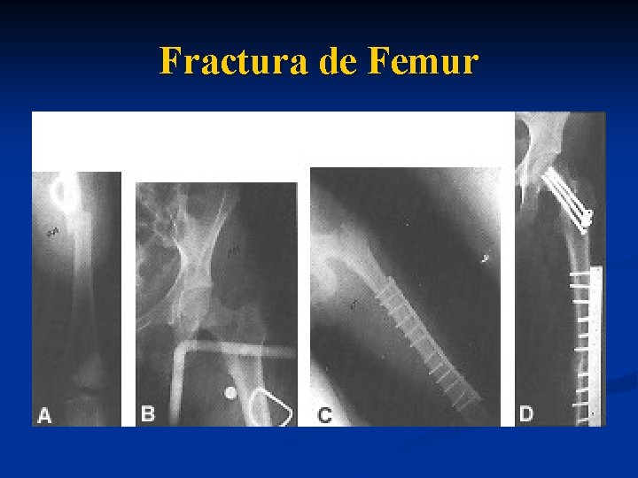 Fractura de Femur 