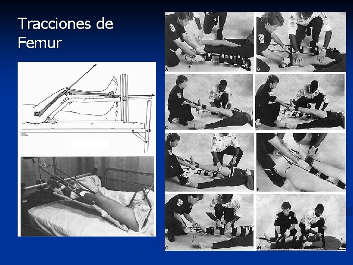 Tracciones de Femur 