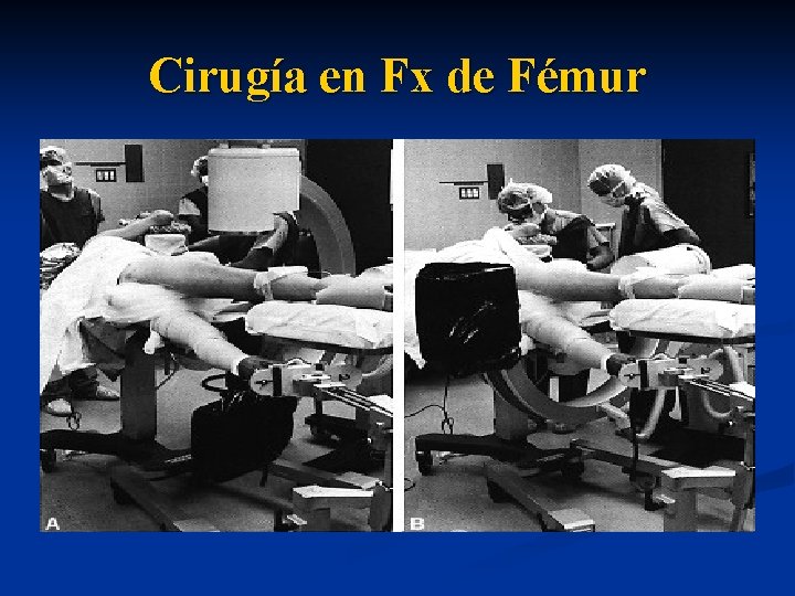 Cirugía en Fx de Fémur 