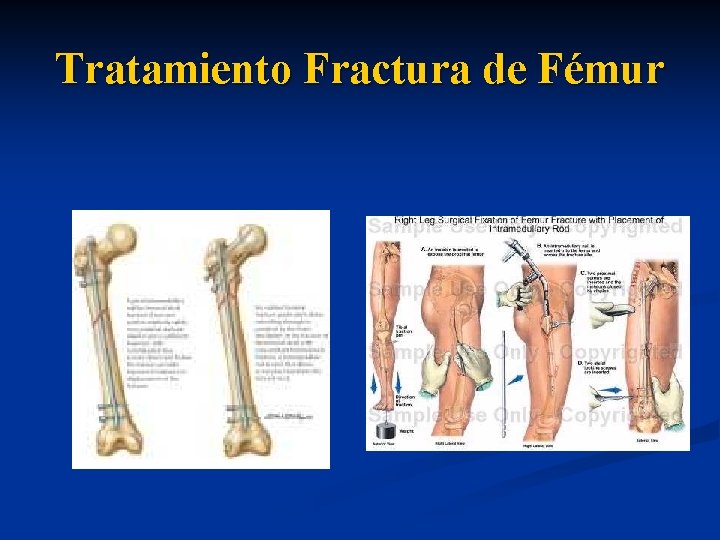 Tratamiento Fractura de Fémur 