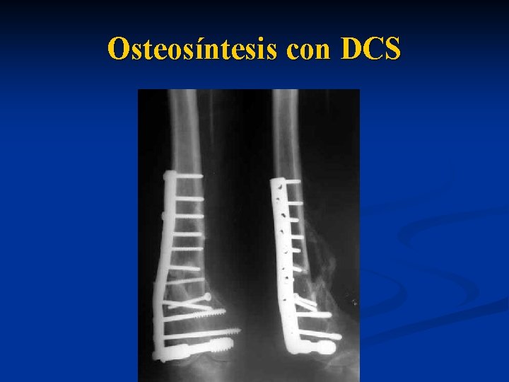 Osteosíntesis con DCS 