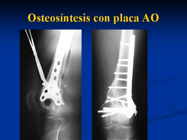 Osteosíntesis con placa AO 