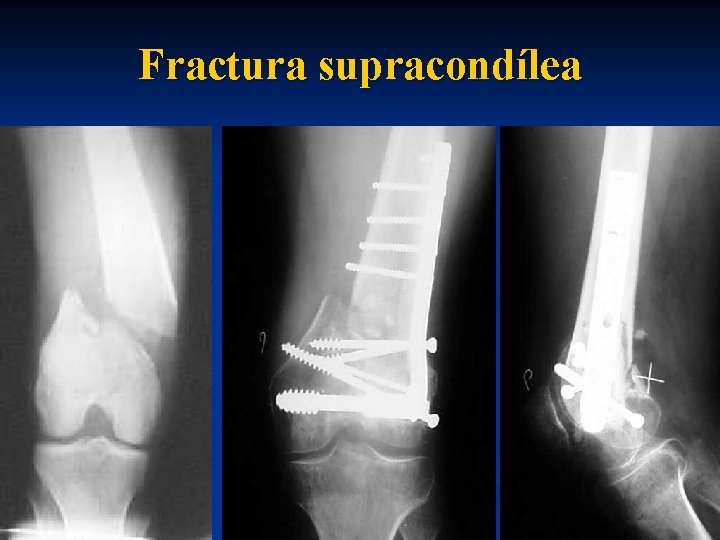  Fractura supracondílea 