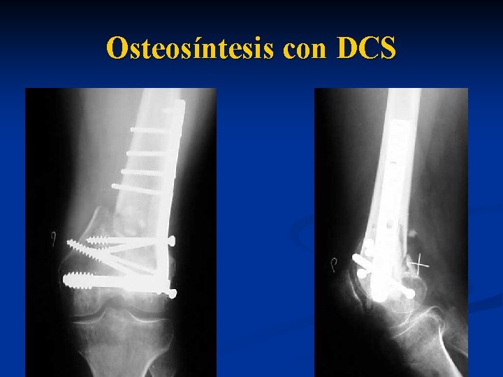 Osteosíntesis con DCS 