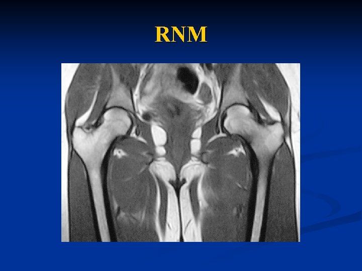 RNM 