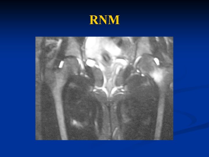 RNM 