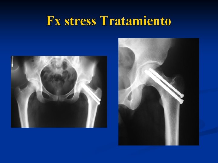 Fx stress Tratamiento 