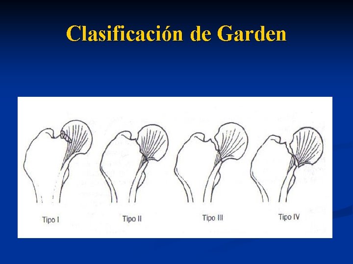 Clasificación de Garden 