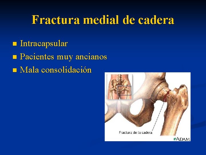 Fractura medial de cadera Intracapsular n Pacientes muy ancianos n Mala consolidación n 