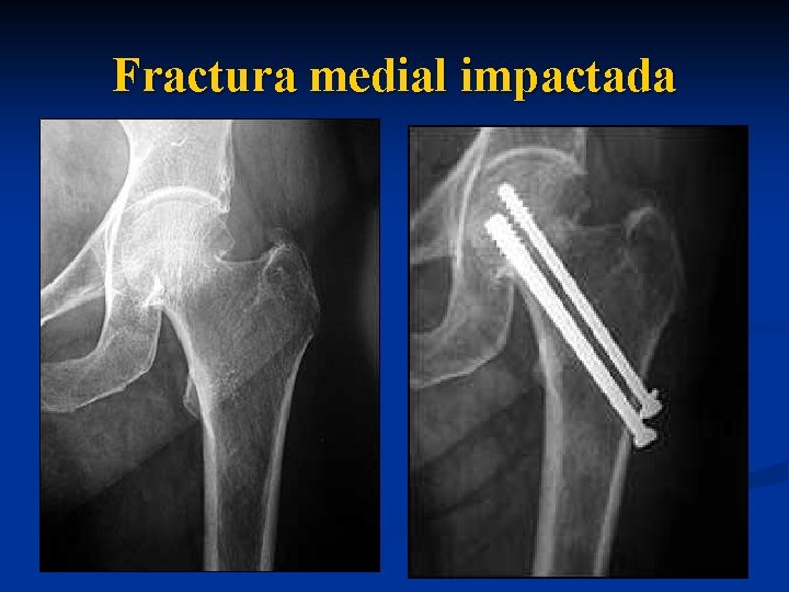 Fractura medial impactada 