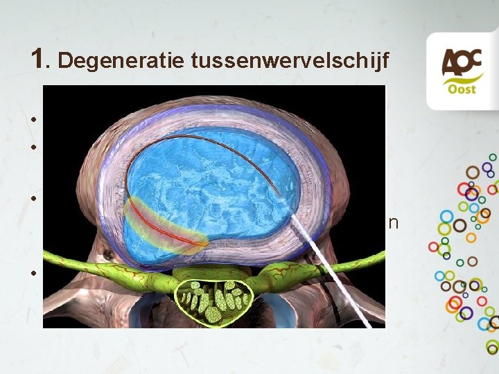 1. Degeneratie tussenwervelschijf • Tussenwervelschijf wordt minder elastisch • Tussenwervelschijf klapt in elkaar ,