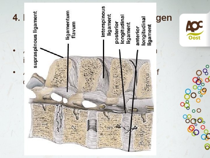 4. Hypertrofie lig flavum/afwijkingen aan de wervelboog • Afwijkingen lig flavium als gevolg van