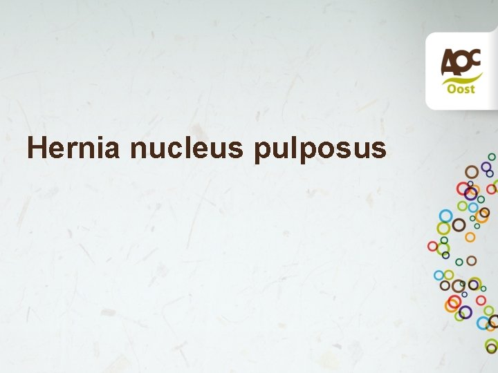 Hernia nucleus pulposus 