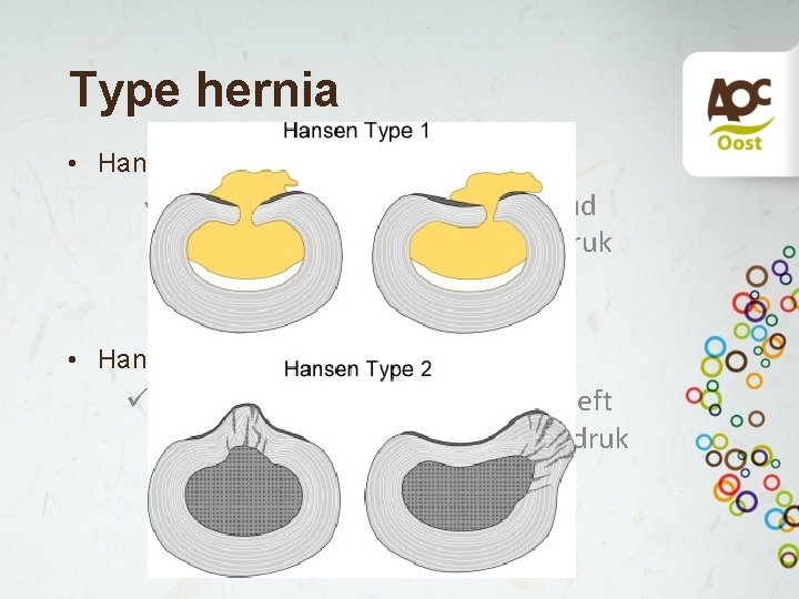 Type hernia • Hansen Type 1 Hernia ü Annulus fibrosis knapt en inhoud komt