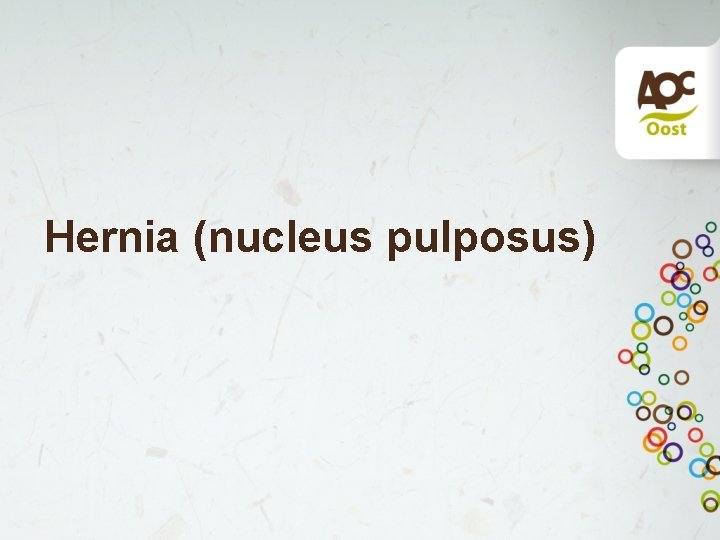 Hernia (nucleus pulposus) 
