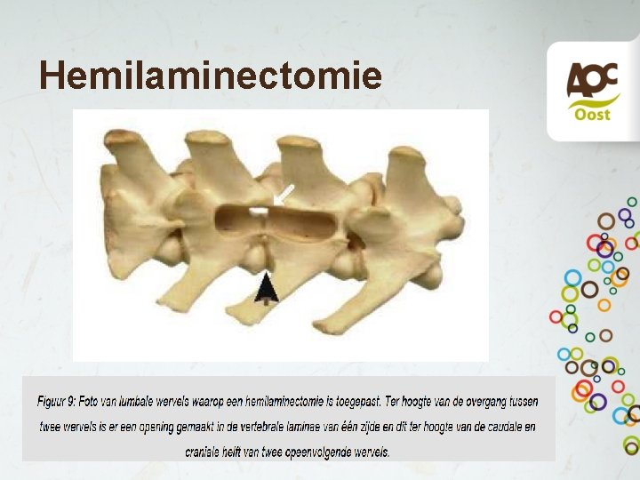 Hemilaminectomie 