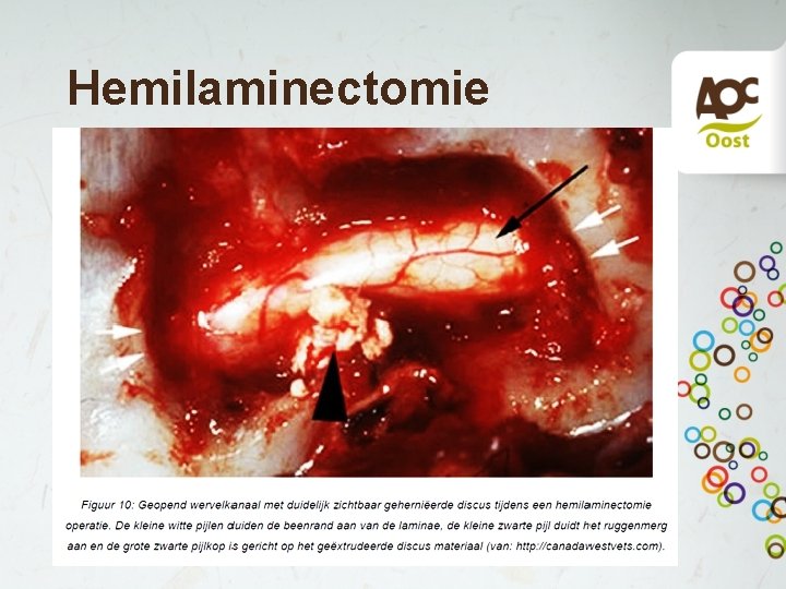 Hemilaminectomie • Meest gebruikt bij thoracolumbale hernia • Bot van beide wervelbogen verwijderd •