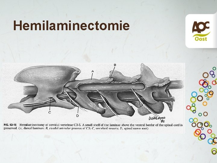 Hemilaminectomie 