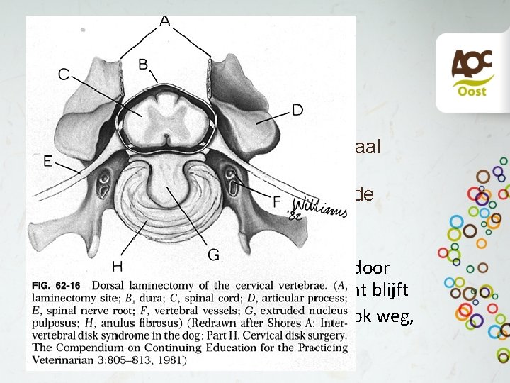 Dorsale laminectomie • Meest logische operatie • Dorsale deel wervelboog met spinaal uitsteeksel verwijderen