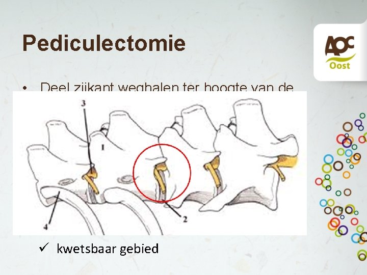 Pediculectomie • Deel zijkant weghalen ter hoogte van de opening waar de zenuwen uittreden