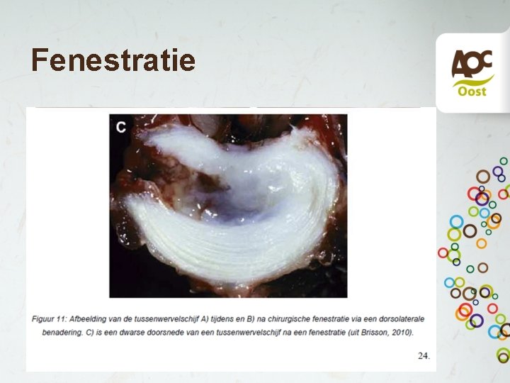 Fenestratie • Tussenwervelschijf wordt geopend • Inwendige wordt zoveel mogelijk verwijderd • Naast gelegen