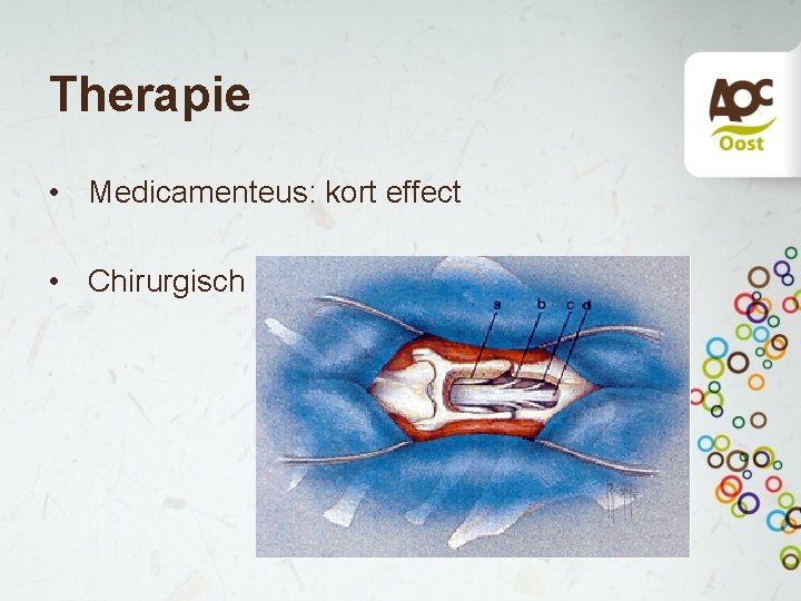 Therapie • Medicamenteus: kort effect • Chirurgisch 