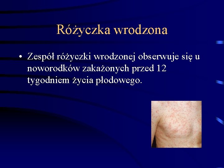 Różyczka wrodzona • Zespół różyczki wrodzonej obserwuje się u noworodków zakażonych przed 12 tygodniem