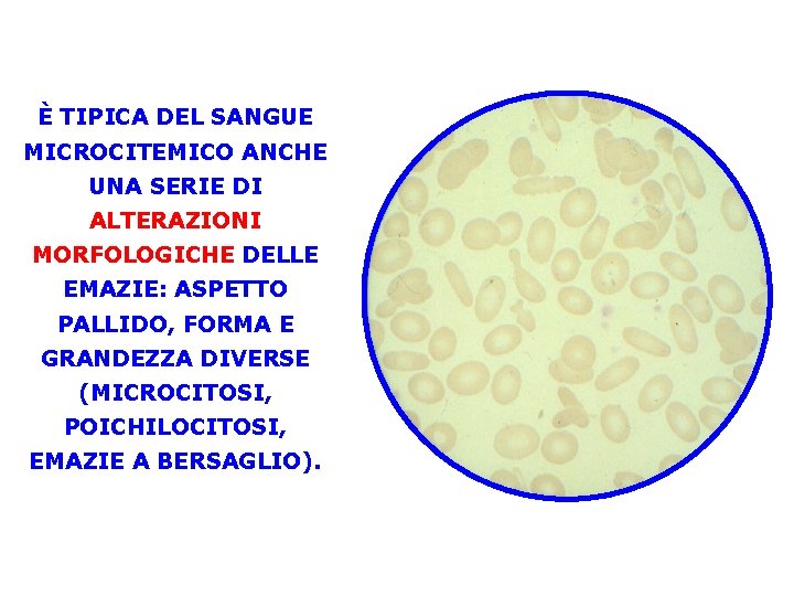 È TIPICA DEL SANGUE MICROCITEMICO ANCHE UNA SERIE DI ALTERAZIONI MORFOLOGICHE DELLE EMAZIE: ASPETTO