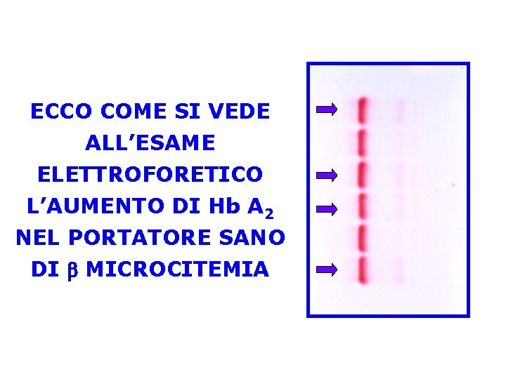 ECCO COME SI VEDE ALL’ESAME ELETTROFORETICO L’AUMENTO DI Hb A 2 NEL PORTATORE SANO