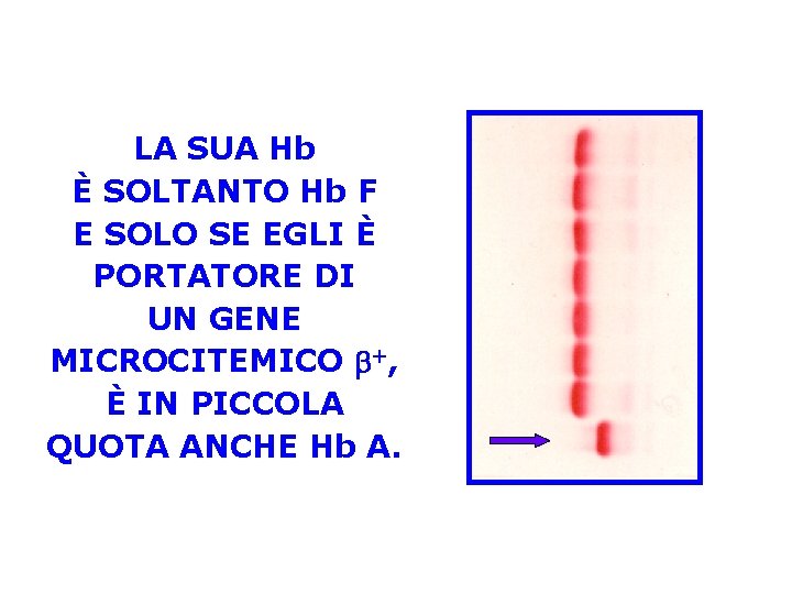 LA SUA Hb È SOLTANTO Hb F E SOLO SE EGLI È PORTATORE DI