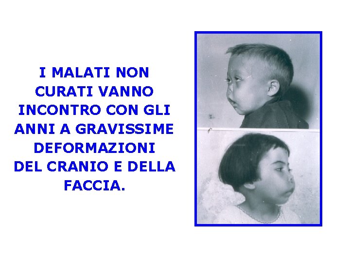 I MALATI NON CURATI VANNO INCONTRO CON GLI ANNI A GRAVISSIME DEFORMAZIONI DEL CRANIO