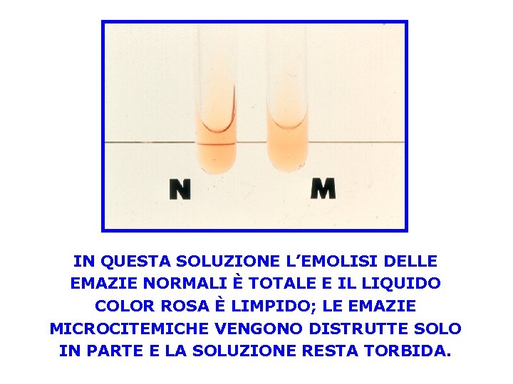 IN QUESTA SOLUZIONE L’EMOLISI DELLE EMAZIE NORMALI È TOTALE E IL LIQUIDO COLOR ROSA