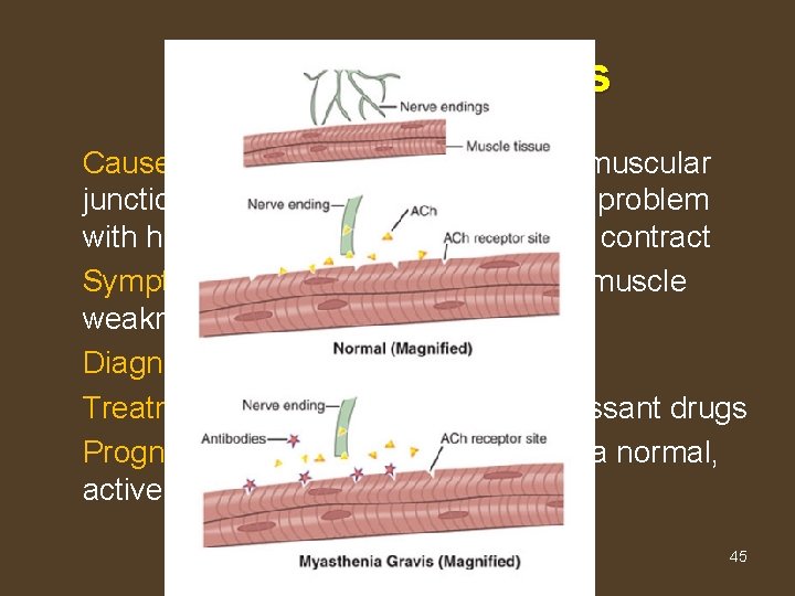 Myasthenia Gravis Cause - Autoimmune attack at neuromuscular junction…affects voluntary muscles…problem with how nerves