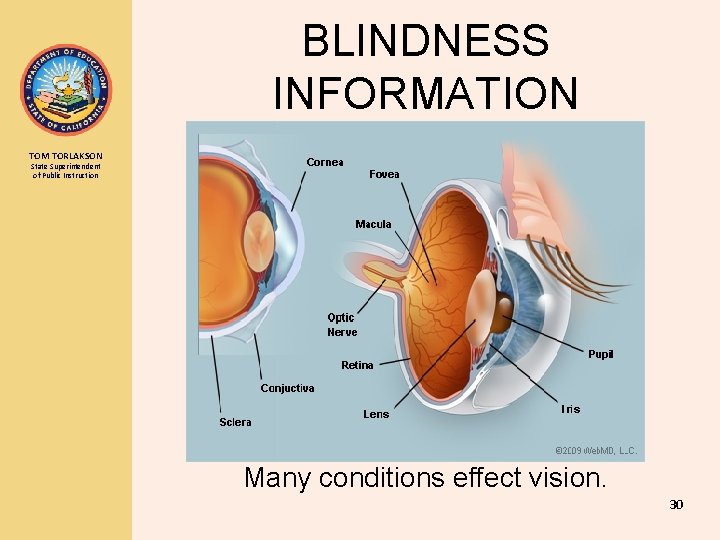 BLINDNESS INFORMATION TOM TORLAKSON State Superintendent of Public Instruction Many conditions effect vision. 30